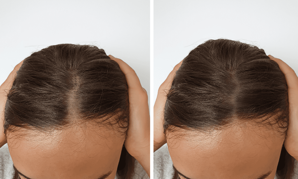 Hair Plugs vs Hair Implants – Everything You Need To Know